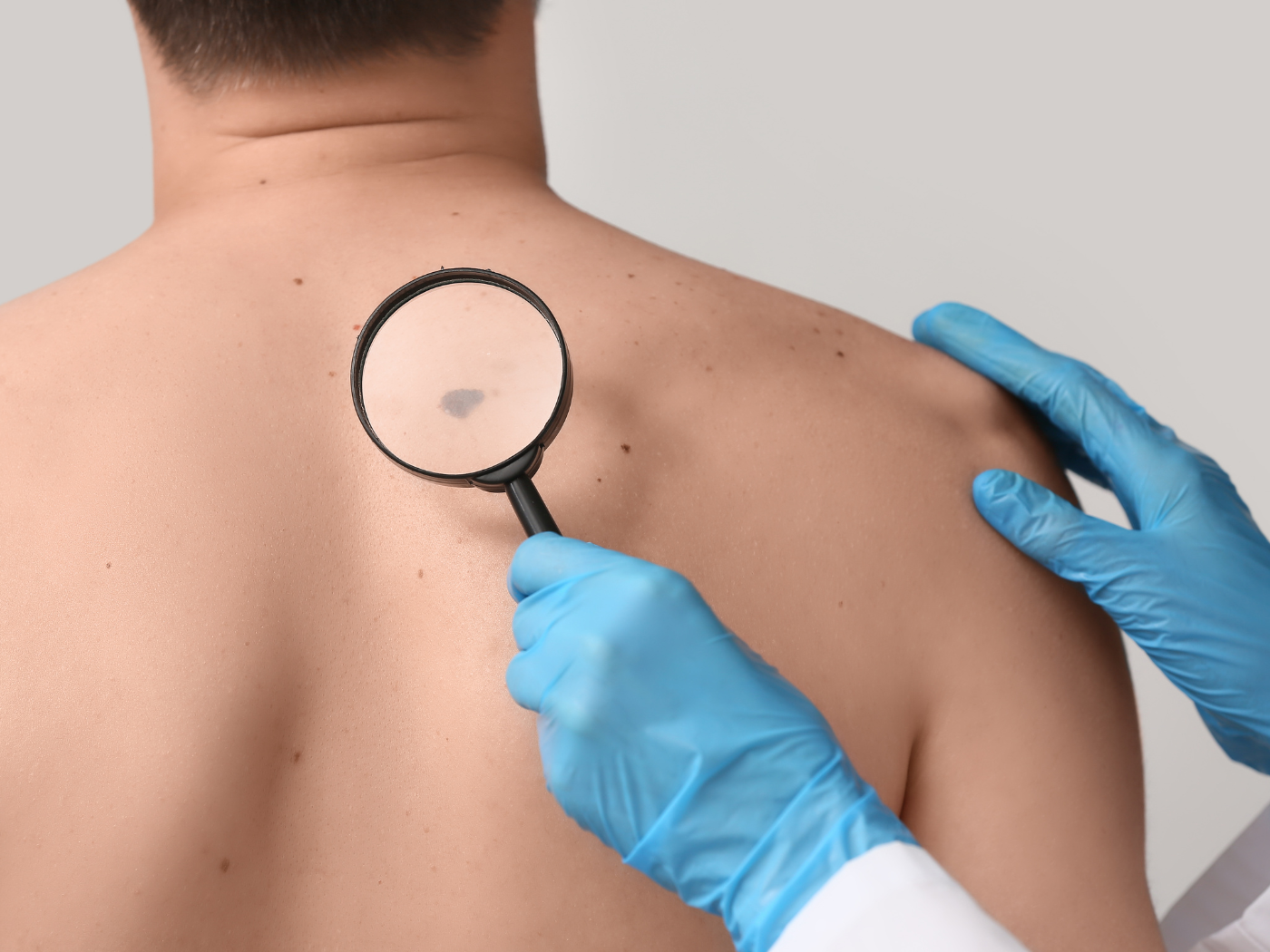 Dia Europeu do Melanoma