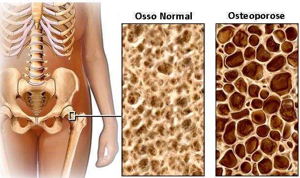 Osteoporose